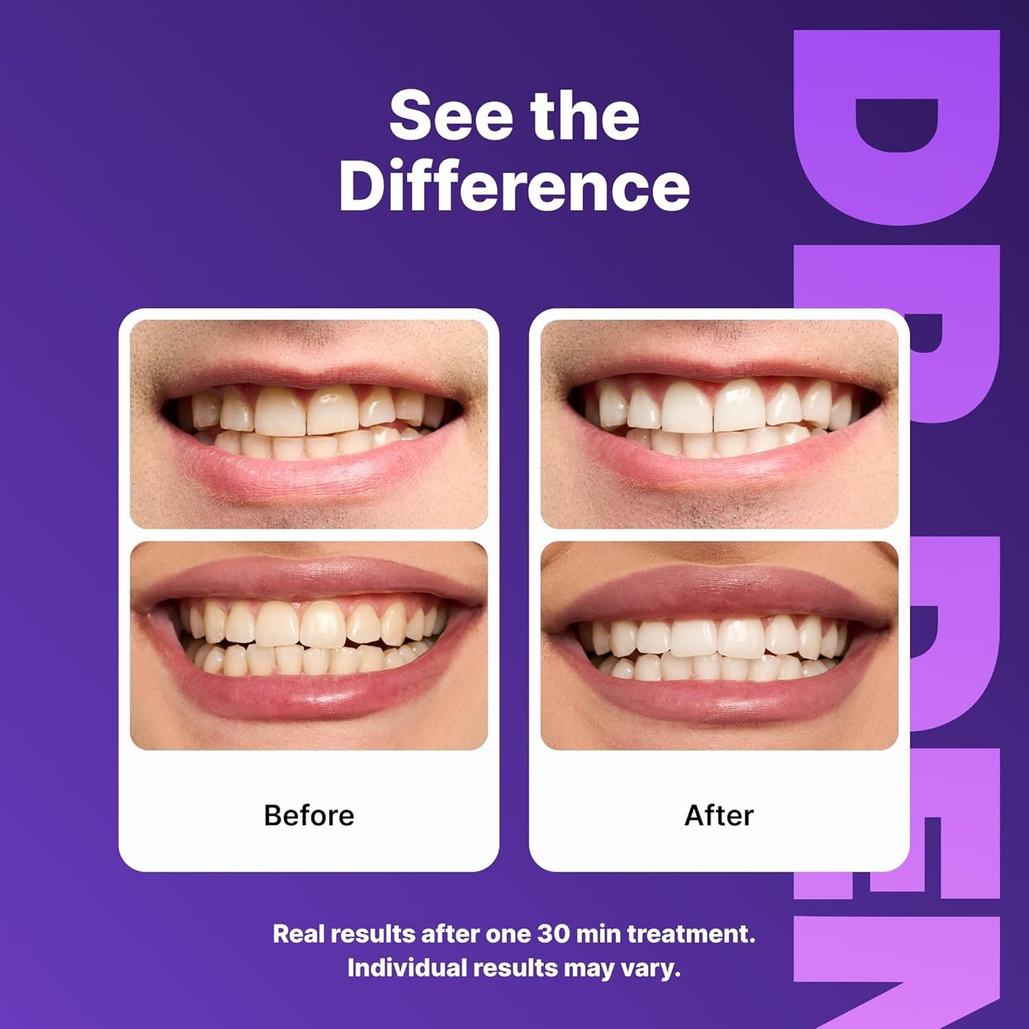 DRDENT شرائط تبييض الأسنان البنفسجية – 21 علاج، آمنة وغير حساسة، 42 شريط + أداة فتح الفم